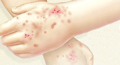 kontakt dermatitis